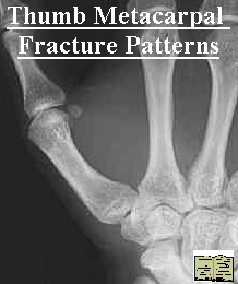 thumb fracture treatment